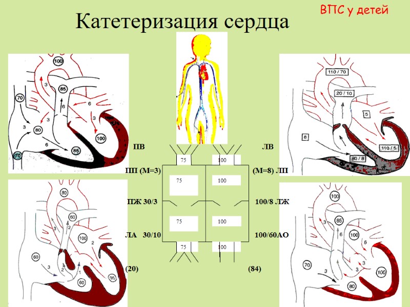 Катетеризация сердца  ВПС у детей     ПВ   